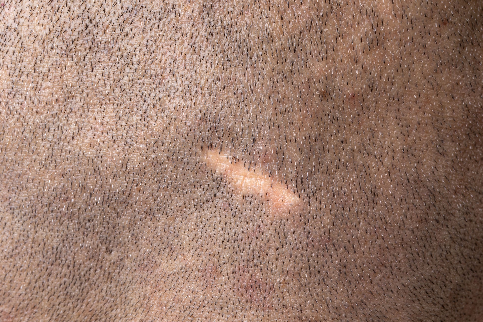 Scalp Micropigmentation Treatments